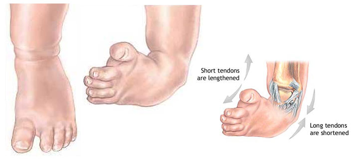 Congenital Talipes Equinovarus Clubfoot Nursing Care Management Nurseslabs