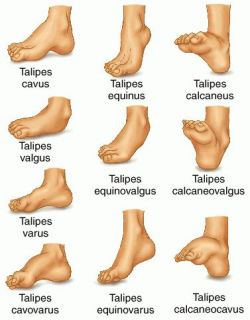 Congenital Talipes Equinovarus Clubfoot Nursing Care Management Nurseslabs