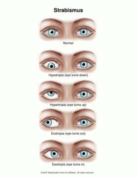 Strabismus Nursing Care Planning and Management - Nurseslabs