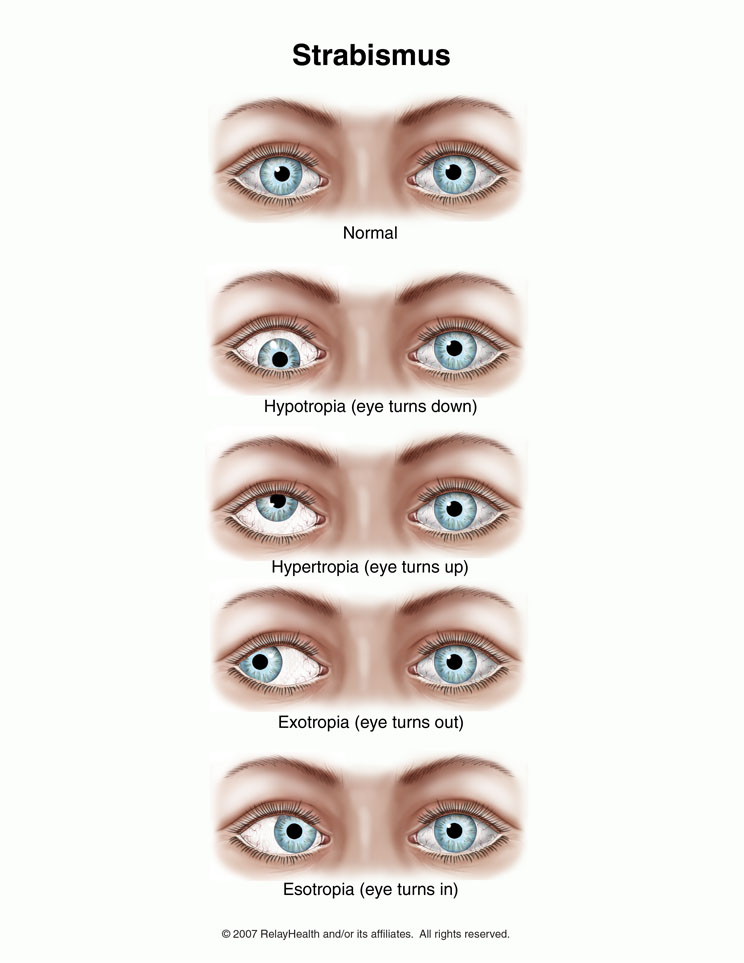 Esotropia (cross-eyed) and its causes and symptoms