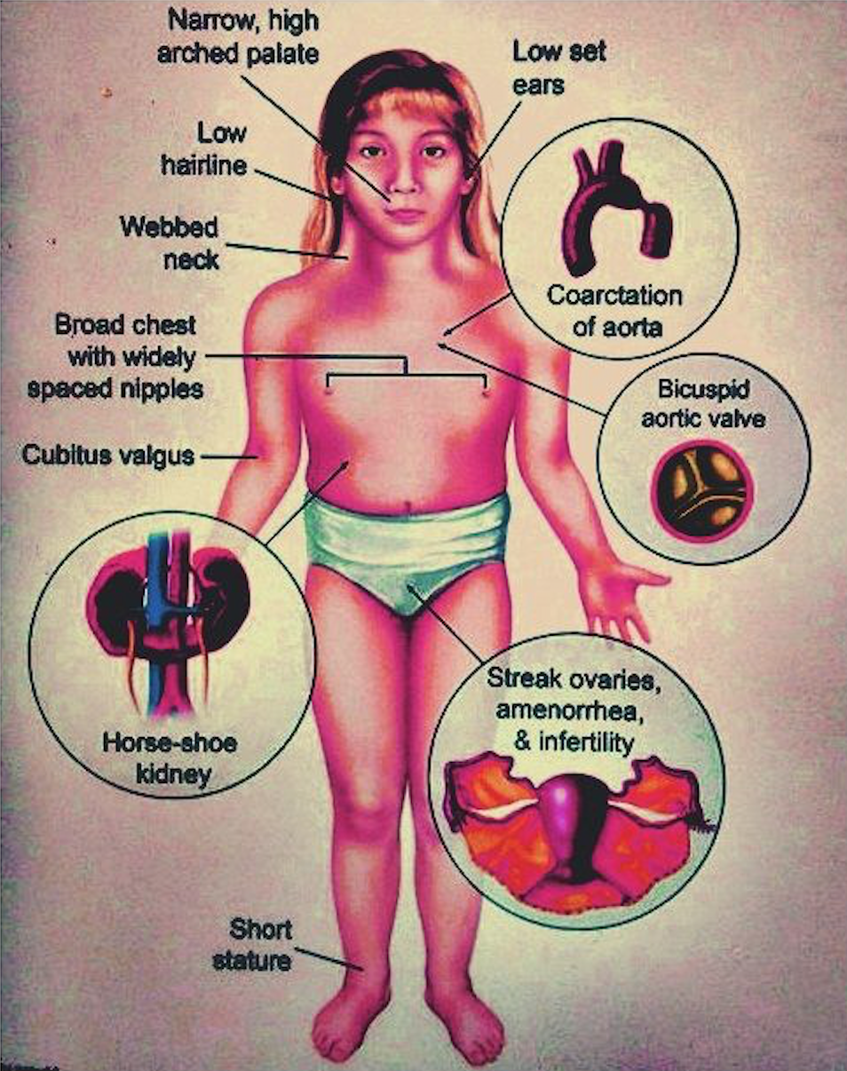 Turner Syndrome Nursing Assessment And Diagnostic Findings Management