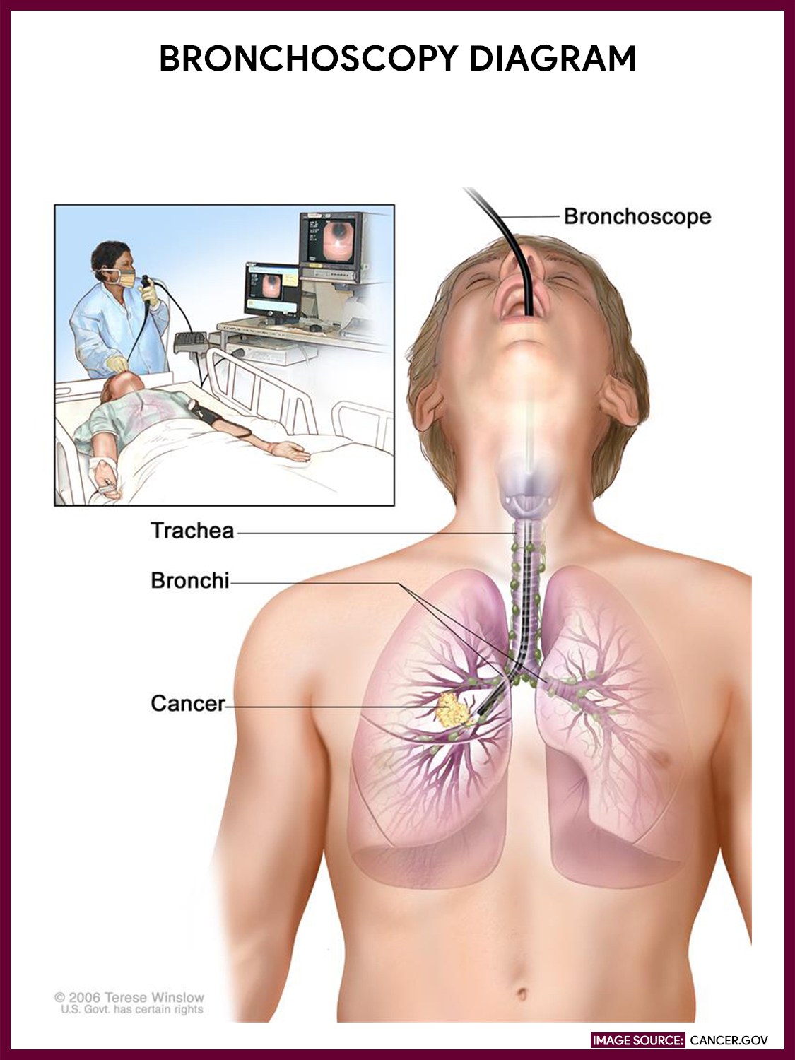 Bronchoscopy Nursing Responsibilities Nurseslabs