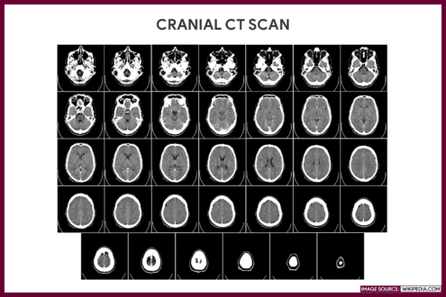 CRANIAL CT WITH IV CONTRAST MEDIUM