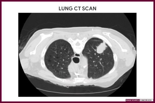 LUNG CT SCAN