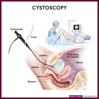 Cystoscopy- Cystoscopy