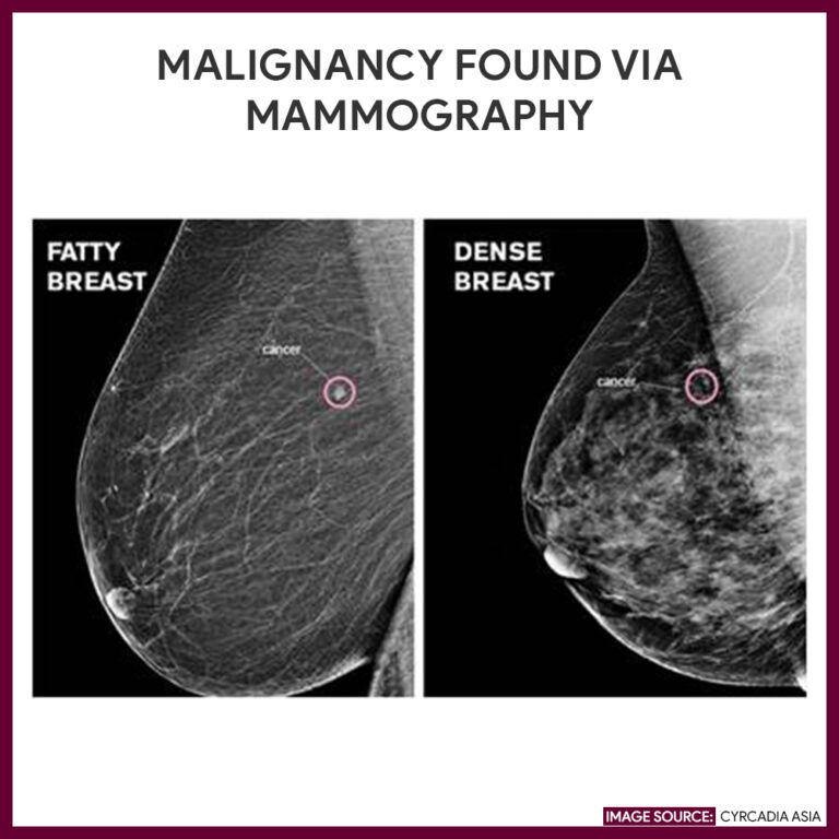 Mammography (Mammogram) - Nursing Responsibilities - Nurseslabs