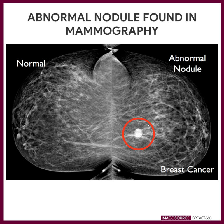 Mammography (Mammogram) Nursing Responsibilities Nurseslabs