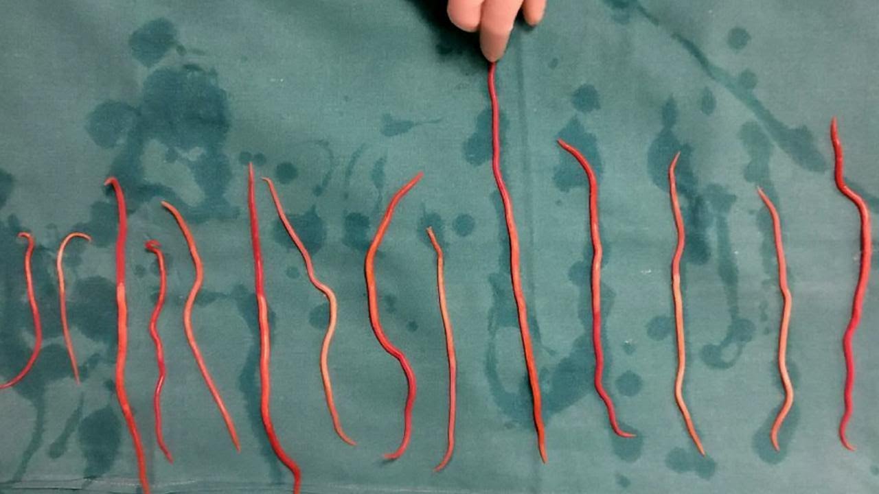 Roundworms (Ascariasis) - Nurseslabs