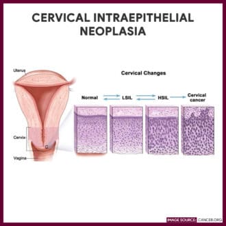 Cervical Intraepithelial Neoplasia-Papsmear