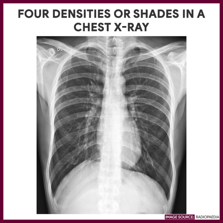 Chest Xray (Chest Radiography) Nursing Responsibilities Nurseslabs