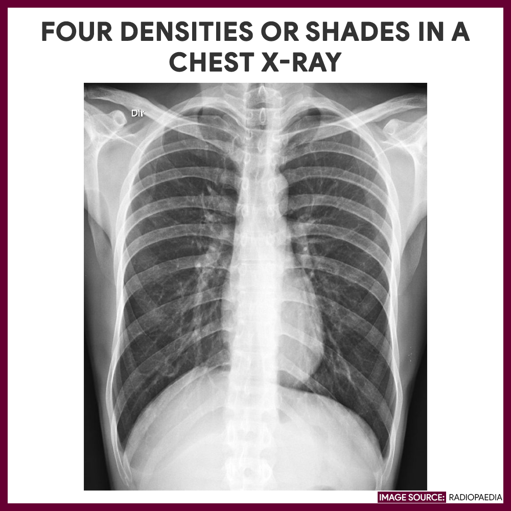 Four densities or shades in a chest x-ray