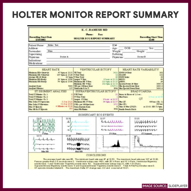 Holter Monitoring Nursing Responsibilities and Care Plan Nurseslabs