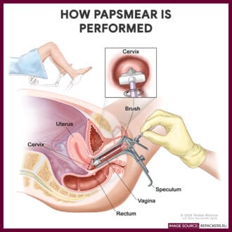 How Pap Smear is Performed - -Papsmear