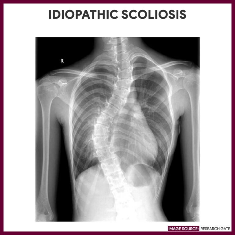 Chest Xray (Chest Radiography) Nursing Responsibilities Nurseslabs