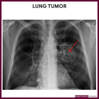 Lung Tumor-Chest-Xray