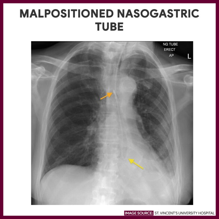 Chest Xray (Chest Radiography) Nursing Responsibilities Nurseslabs