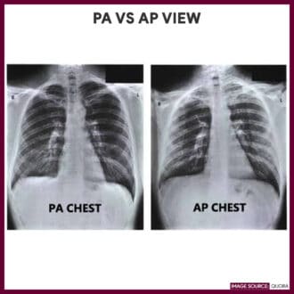 Difference between posteroanterior (PA) view and anteroposterior (AP) view