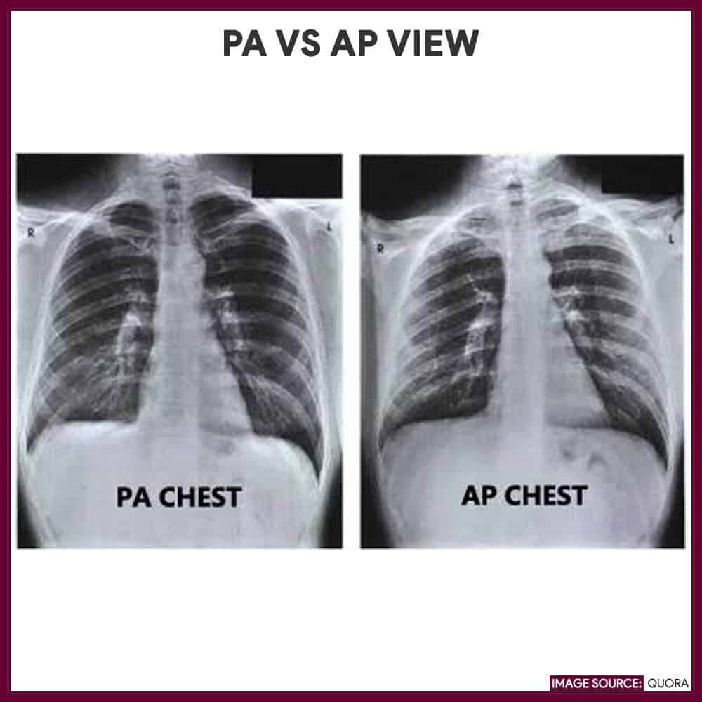 Chest X ray Chest Radiography Nursing Responsibilities Nurseslabs