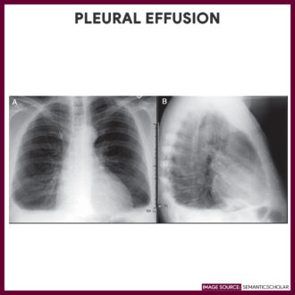 Pleural Effusion-Chest-Xray