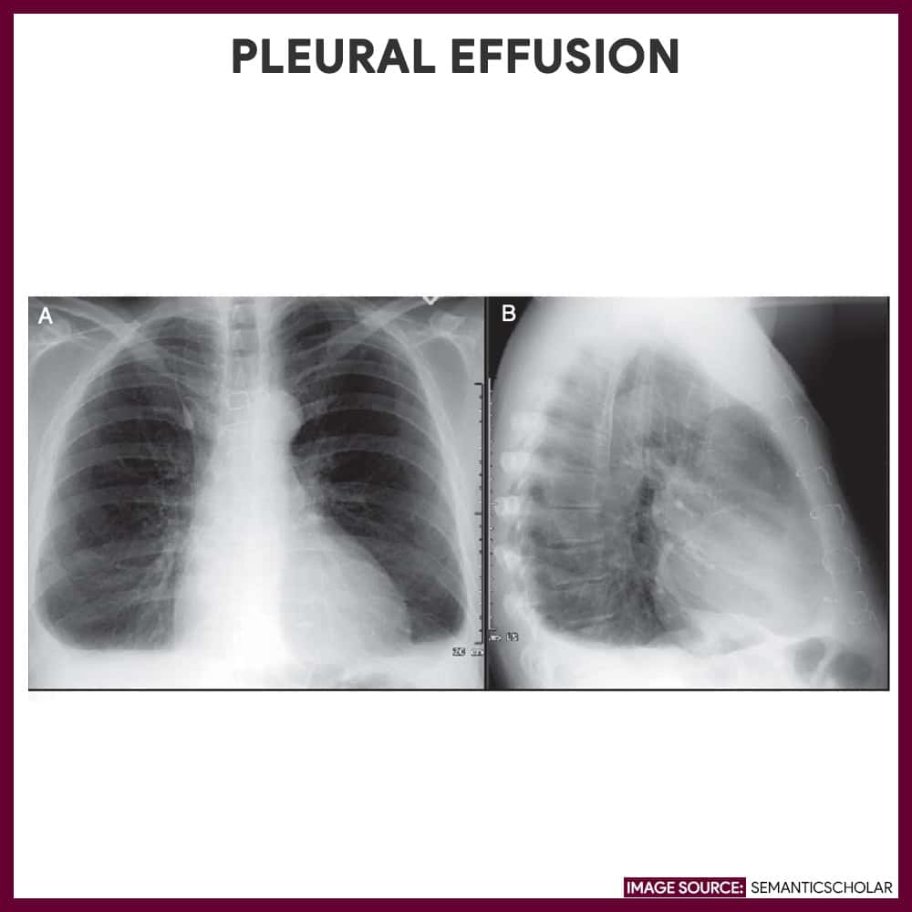 Chest X Ray Pleural Effusion