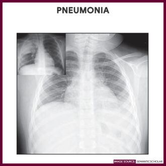 Pneumonia-Chest-Xray