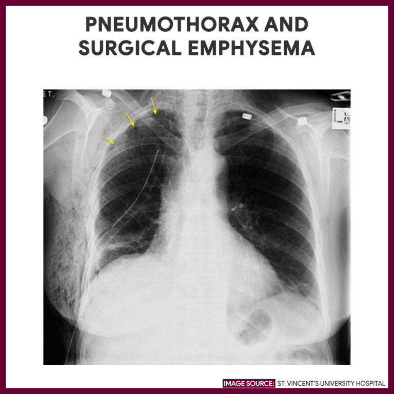 Chest Xray (Chest Radiography) Nursing Responsibilities Nurseslabs