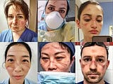 Healthcare workers fighting the COVID-19 showing their battlescars from prolonged PPE use.