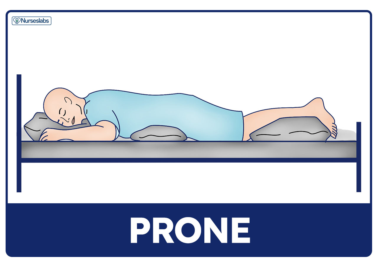 In prone position, the patient lies on the abdomen with their head turned to one side and the hips are not flexed.